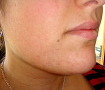 After Treatment